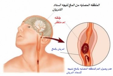 انسداد الشريان